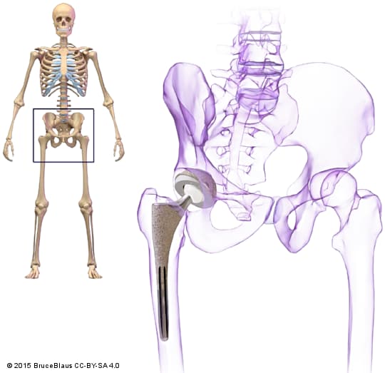 эндопротезирование (замена) тазобедренного и коленного сустава в Сочи - доктор Вакуленко