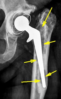 эндопротезирование (замена) тазобедренного и коленного сустава в Сочи - доктор Вакуленко