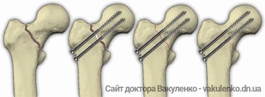 Схема остеосинтеза винтами при лечении перелома шейки бедра. Сращение перелома наступает приблизительно через 4 месяца после такой операции.