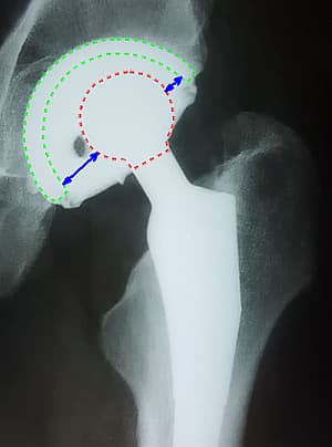 Так выглядит изношенный полиэтиленовый лайнер на рентгенограмме. Синие стрелки показывают его толщину в наиболее (вверху) и наименее (внизу) нагружаемых частях